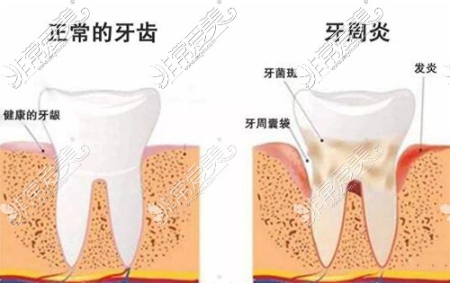中源协和：人牙髓间充质干细胞注射液治疗慢性牙周炎已完成受试者入组